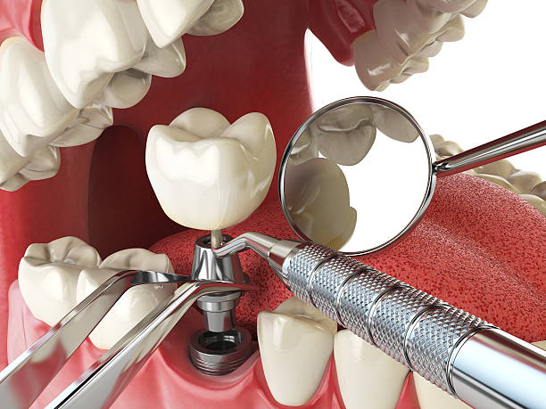 Best Emergency Dental Care for Broken or Chipped Teeth in Jonesboro, IL